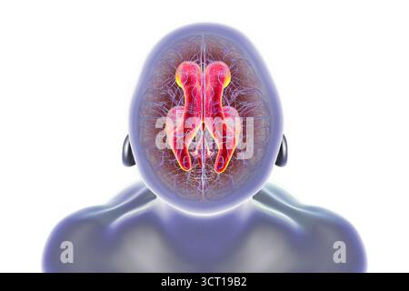 Illustration d'un cerveau humain avec hydrocéphalie à pression normale. Il s'agit d'un trouble chez les adultes plus âgés où le liquide céphalo-rachidien (LCR) s'accumule dans les ventricules du cerveau, causant des ventricules élargis et une compression des tissus cérébraux. Banque D'Images