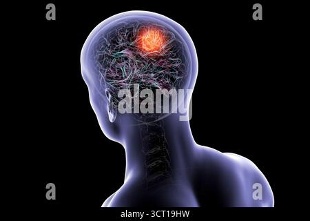 Illustration d'une tumeur cérébrale. Une tumeur cérébrale est une masse de cellules anormales qui se développent dans le cerveau. Il existe plus de 130 types de tumeurs cérébrales primitives. Ils sont nommés selon le type de cellules ou la partie du cerveau dans laquelle ils commencent. Banque D'Images
