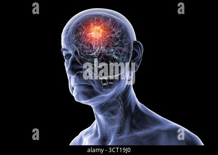 Illustration d'une tumeur cérébrale chez une personne âgée. Une tumeur cérébrale est une masse de cellules anormales qui se développent dans le cerveau. Il existe plus de 130 types de tumeurs cérébrales primitives. Ils sont nommés selon le type de cellules ou la partie du cerveau dans laquelle ils commencent. Banque D'Images