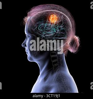 Illustration d'une tumeur cérébrale. Une tumeur cérébrale est une masse de cellules anormales qui se développent dans le cerveau. Il existe plus de 130 types de tumeurs cérébrales primitives. Ils sont nommés selon le type de cellules ou la partie du cerveau dans laquelle ils commencent. Banque D'Images