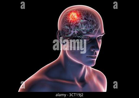 Illustration d'une tumeur cérébrale. Une tumeur cérébrale est une masse de cellules anormales qui se développent dans le cerveau. Il existe plus de 130 types de tumeurs cérébrales primitives. Ils sont nommés selon le type de cellules ou la partie du cerveau dans laquelle ils commencent. Banque D'Images