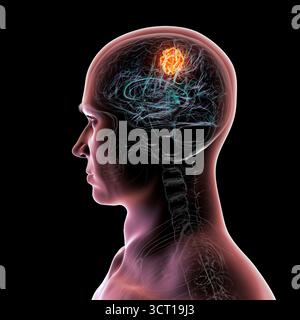 Illustration d'une tumeur cérébrale. Une tumeur cérébrale est une masse de cellules anormales qui se développent dans le cerveau. Il existe plus de 130 types de tumeurs cérébrales primitives. Ils sont nommés selon le type de cellules ou la partie du cerveau dans laquelle ils commencent. Banque D'Images