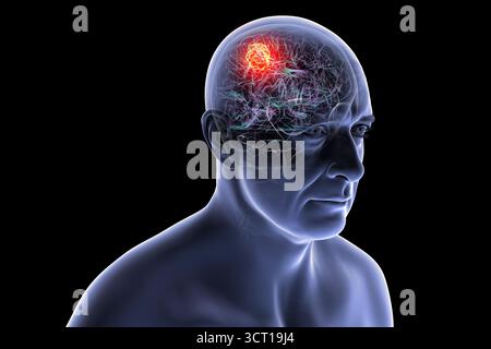 Illustration d'une tumeur cérébrale. Une tumeur cérébrale est une masse de cellules anormales qui se développent dans le cerveau. Il existe plus de 130 types de tumeurs cérébrales primitives. Ils sont nommés selon le type de cellules ou la partie du cerveau dans laquelle ils commencent. Banque D'Images