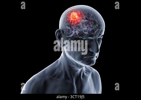 Illustration d'une tumeur cérébrale chez une personne âgée. Une tumeur cérébrale est une masse de cellules anormales qui se développent dans le cerveau. Il existe plus de 130 types de tumeurs cérébrales primitives. Ils sont nommés selon le type de cellules ou la partie du cerveau dans laquelle ils commencent. Banque D'Images