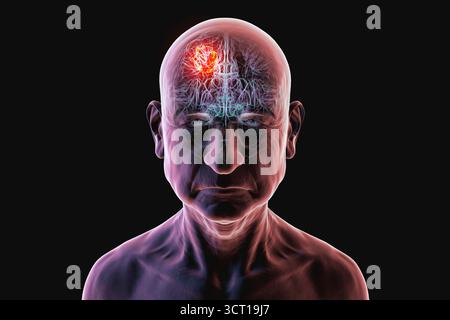 Illustration d'une tumeur cérébrale chez une personne âgée. Une tumeur cérébrale est une masse de cellules anormales qui se développent dans le cerveau. Il existe plus de 130 types de tumeurs cérébrales primitives. Ils sont nommés selon le type de cellules ou la partie du cerveau dans laquelle ils commencent. Banque D'Images