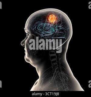 Illustration d'une tumeur cérébrale. Une tumeur cérébrale est une masse de cellules anormales qui se développent dans le cerveau. Il existe plus de 130 types de tumeurs cérébrales primitives. Ils sont nommés selon le type de cellules ou la partie du cerveau dans laquelle ils commencent. Banque D'Images