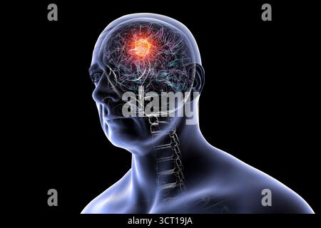 Illustration d'une tumeur cérébrale. Une tumeur cérébrale est une masse de cellules anormales qui se développent dans le cerveau. Il existe plus de 130 types de tumeurs cérébrales primitives. Ils sont nommés selon le type de cellules ou la partie du cerveau dans laquelle ils commencent. Banque D'Images