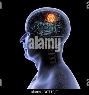 Illustration d'une tumeur cérébrale. Une tumeur cérébrale est une masse de cellules anormales qui se développent dans le cerveau. Il existe plus de 130 types de tumeurs cérébrales primitives. Ils sont nommés selon le type de cellules ou la partie du cerveau dans laquelle ils commencent. Banque D'Images