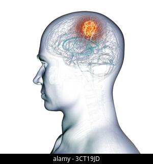Illustration d'une tumeur cérébrale. Une tumeur cérébrale est une masse de cellules anormales qui se développent dans le cerveau. Il existe plus de 130 types de tumeurs cérébrales primitives. Ils sont nommés selon le type de cellules ou la partie du cerveau dans laquelle ils commencent. Banque D'Images