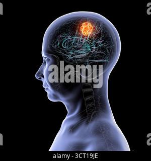 Illustration d'une tumeur cérébrale. Une tumeur cérébrale est une masse de cellules anormales qui se développent dans le cerveau. Il existe plus de 130 types de tumeurs cérébrales primitives. Ils sont nommés selon le type de cellules ou la partie du cerveau dans laquelle ils commencent. Banque D'Images