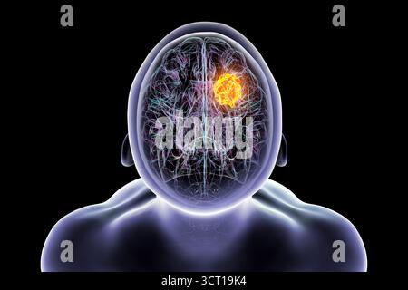 Illustration d'une tumeur cérébrale. Une tumeur cérébrale est une masse de cellules anormales qui se développent dans le cerveau. Il existe plus de 130 types de tumeurs cérébrales primitives. Ils sont nommés selon le type de cellules ou la partie du cerveau dans laquelle ils commencent. Banque D'Images