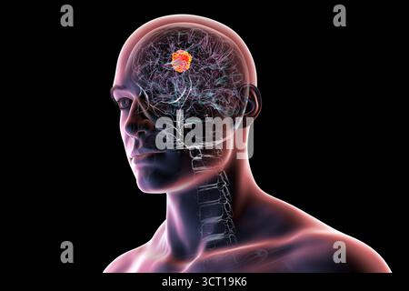 Illustration d'une tumeur cérébrale. Une tumeur cérébrale est une masse de cellules anormales qui se développent dans le cerveau. Il existe plus de 130 types de tumeurs cérébrales primitives. Ils sont nommés selon le type de cellules ou la partie du cerveau dans laquelle ils commencent. Banque D'Images