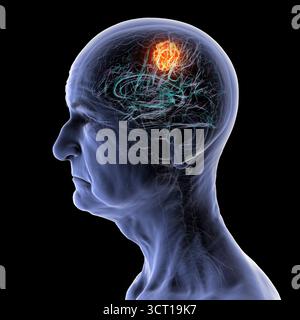 Illustration d'une tumeur cérébrale chez une personne âgée. Une tumeur cérébrale est une masse de cellules anormales qui se développent dans le cerveau. Il existe plus de 130 types de tumeurs cérébrales primitives. Ils sont nommés selon le type de cellules ou la partie du cerveau dans laquelle ils commencent. Banque D'Images