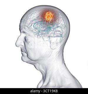 Illustration d'une tumeur cérébrale chez une personne âgée. Une tumeur cérébrale est une masse de cellules anormales qui se développent dans le cerveau. Il existe plus de 130 types de tumeurs cérébrales primitives. Ils sont nommés selon le type de cellules ou la partie du cerveau dans laquelle ils commencent. Banque D'Images