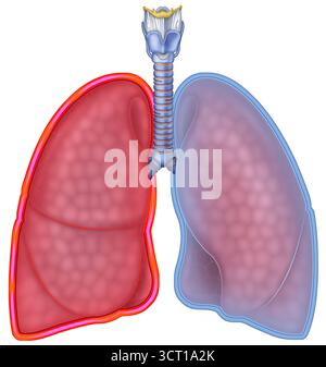 Illustration d’un poumon atteint d’inflammation causée par une pleurésie ou une pleurite, caractérisée par une douleur aiguë qui s’aggrave avec une respiration profonde, une toux ou des éternuements. Les causes incluent les infections virales ou bactériennes, les blessures thoraciques, le pneumothorax, les tumeurs ou les maladies telles que la tuberculose, le lupus ou l'insuffisance cardiaque. Banque D'Images