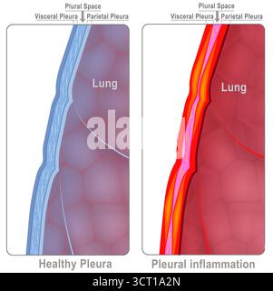 Illustration montrant les couches de la plèvre pulmonaire. L'un d'eux est atteint de pleurésie ou de pleurite. Cette inflammation se caractérise par une douleur aiguë et poignarante dans la poitrine, qui s’aggrave lors de la prise d’une respiration profonde, de la toux ou des éternuements. Les causes sont variées et incluent des infections virales ou bactériennes. Banque D'Images