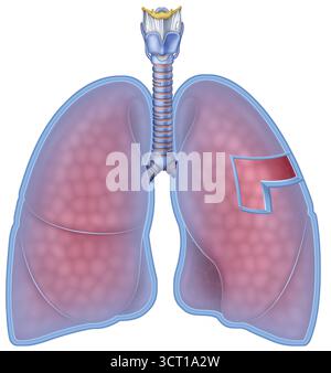 Illustration de la plèvre pulmonaire, la membrane entourant les poumons. La couche viscérale recouvrant la surface pulmonaire et la couche pariétale recouvrant la cavité thoracique sont éclairées. La plèvre pulmonaire facilite la mobilité pulmonaire pendant la respiration. Banque D'Images