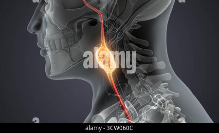 Tumeur du paragangliome neuroendocrine chez l'homme Banque D'Images