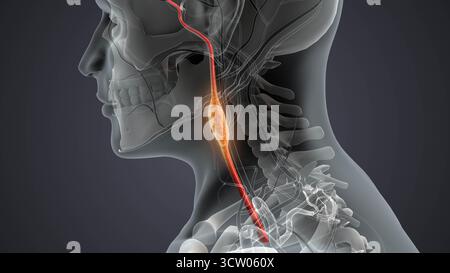 Tumeur du paragangliome neuroendocrine chez l'homme Banque D'Images