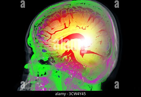 Radiographie du crâne en vue AP (antérieure-postérieure), montrant une structure osseuse claire sans anomalies visibles. Banque D'Images