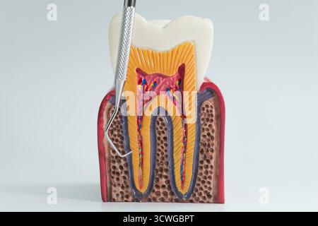 Modèle anatomique détaillé montrant la structure interne d'une dent humaine, y compris la pulpe, la dentine, l'émail et la racine avec un outil dentaire. Banque D'Images
