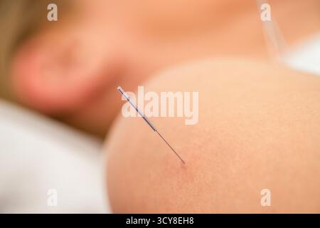 Femme recevant un traitement d'aiguilletage sec sur son épaule pendant une séance de physiothérapie. Le traitement cible la tension musculaire, le soulagement de la douleur et améliore la mobilité pour la rééducation. Banque D'Images