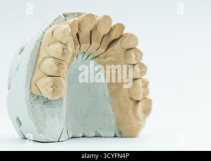 Gros plan d'un modèle de plâtre sectionné montrant la voûte dentaire supérieure, utilisé en dentisterie restauratrice et dans les procédures de pose de couronne. Banque D'Images