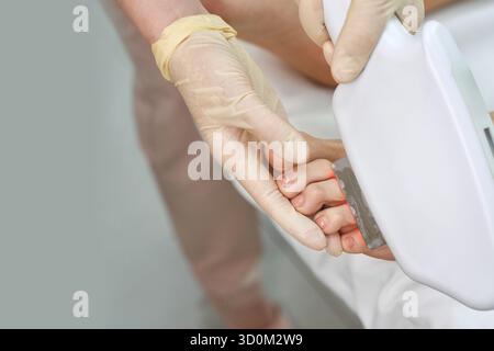 Gros plan d'un traitement au laser des orteils par la main d'une femme gantée sur le pied d'une patiente en clinique médicale pour l'élimination des champignons. Banque D'Images