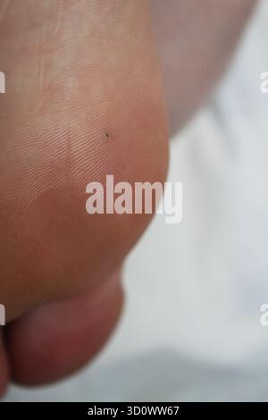 un point noir sur la plante du pied. Gros plan sur le traitement des pieds. Banque D'Images