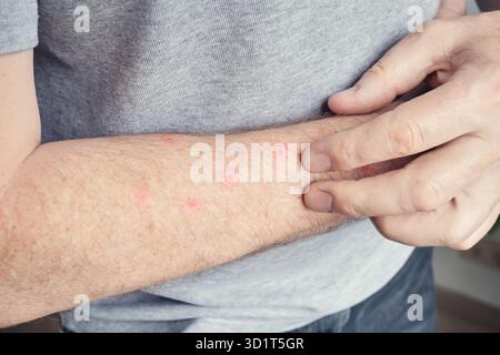 Homme caucasien examinant des bosses rouges sur une éruption cutanée de l'avant-bras Banque D'Images