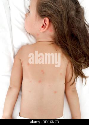 Dos d'enfant mordu par les moustiques. Marques de morsure sur le dos. Un enfant mordu par des moustiques et des insectes. Banque D'Images