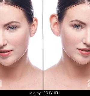La fille avant et après chirurgie plastique cosmétologique. Résultat de l'opération du problème. Procédé de retrait d'un patient en soins de santé. Bourdonnement esthétique Banque D'Images