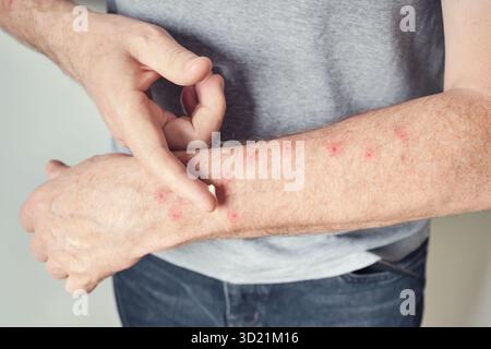 Homme adulte avec éruption cutanée appliquant le traitement aux taches irritées sur le bras Banque D'Images