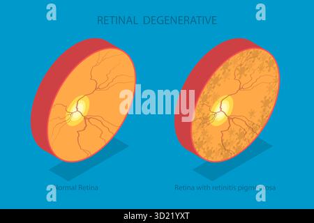 Illustration 3D isométrique plate de dégénérescence rétinienne, troubles de la vision, taches aveugles Banque D'Images