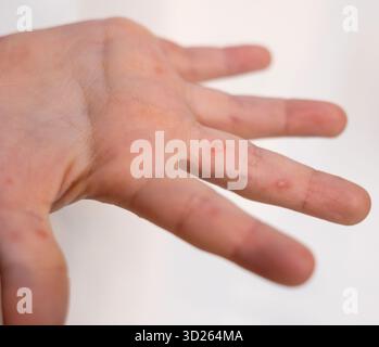 Main d'enfant montrant des signes visibles de maladie des mains, des pieds et de la bouche, avec de petites cloques rouges apparaissant sur la paume et les doigts, indiquant une infection virale Banque D'Images