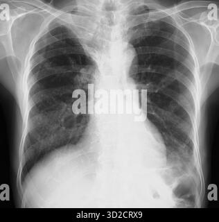 Poumon affaissé. Radiographie thoracique montrant une atélectasie pulmonaire dans le lobe supérieur droit (collapsus). Banque D'Images