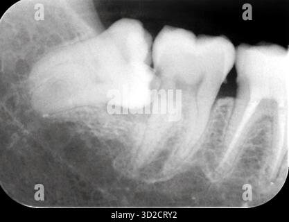 Dent de sagesse incluse, radiographie. Banque D'Images