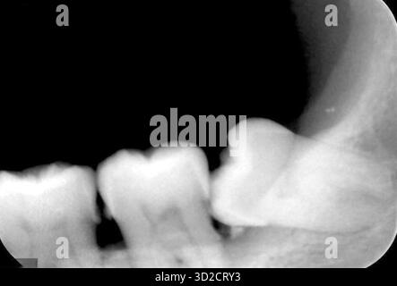 Dent de sagesse incluse, radiographie. Banque D'Images