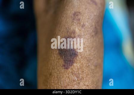 allergie cutanée en gros plan d'un avant-bras âgé avec ecchymose violet foncé visible et petites taches rouges Banque D'Images