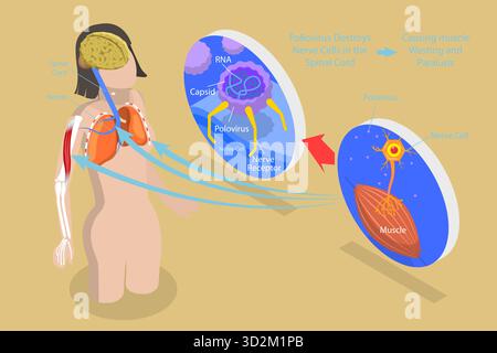 Illustration conceptuelle 3D Isométrique plate de la poliomyélite, étiqueté Medical virus infection Symptems explication Scheme illustration conceptuelle 3D Isométrique plate de la poliomyélite, étiqueté Medical virus infection Symptems explication Scheme Banque D'Images
