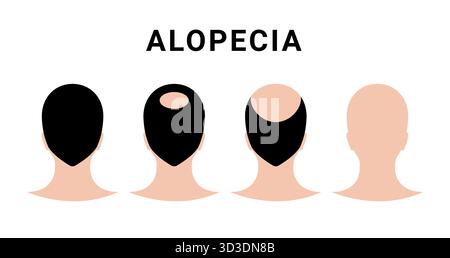 Alopécie capillaire tête homme. Perte masculine de cheveux de greffe de tête à vecteur chauve Illustration de Vecteur