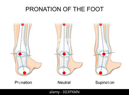 Pronation et supination du pied. Jambe humaine, vue arrière. Illustration vectorielle qui aide à choisir les bonnes chaussures pour soutenir le type de pied. Illustration de Vecteur