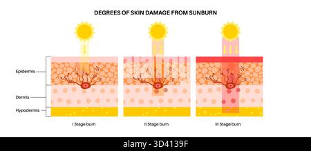 Illustration de la représentation des degrés de dommages cutanés causés par un coup de soleil. Les brûlures au premier degré affectent la couche externe de la peau et provoquent des rougeurs ; les brûlures au deuxième degré endommagent les couches plus profondes de la peau, entraînant des cloques ; les brûlures au troisième degré endommagent gravement toutes les couches de la peau et nécessitent une attention médicale urgente. Banque D'Images