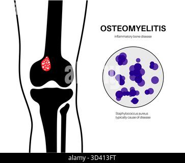 Illustration d'une ostéomyélite osseuse du tibia. Il s'agit d'une infection de l'os du tibia, généralement causée par la bactérie Staphylococcus aureus. Banque D'Images