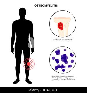 Illustration d'une ostéomyélite osseuse du tibia. Il s'agit d'une infection de l'os du tibia, généralement causée par la bactérie Staphylococcus aureus. Banque D'Images