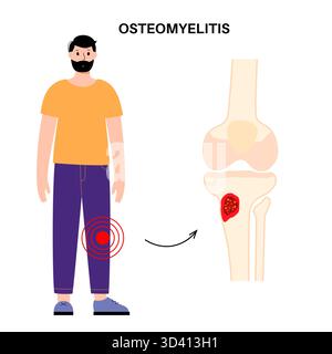 Illustration d'une ostéomyélite osseuse du tibia. Il s'agit d'une infection de l'os du tibia, généralement causée par la bactérie Staphylococcus aureus. Banque D'Images