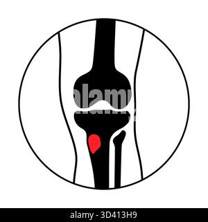 Illustration d'une ostéomyélite osseuse du tibia. Il s'agit d'une infection de l'os du tibia, généralement causée par la bactérie Staphylococcus aureus. Banque D'Images