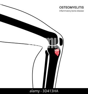 Illustration d'une ostéomyélite osseuse du tibia. Il s'agit d'une infection de l'os du tibia, généralement causée par la bactérie Staphylococcus aureus. Banque D'Images