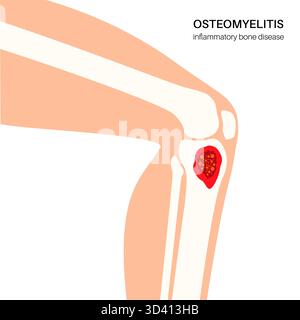 Illustration d'une ostéomyélite osseuse du tibia. Il s'agit d'une infection de l'os du tibia, généralement causée par la bactérie Staphylococcus aureus. Banque D'Images