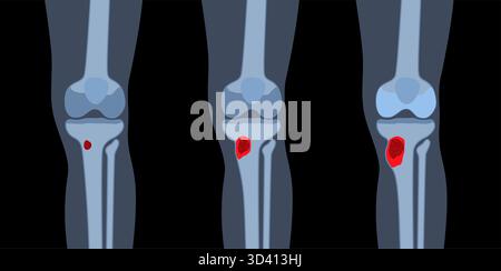 Illustration d'une ostéomyélite osseuse du tibia. Il s'agit d'une infection de l'os du tibia, généralement causée par la bactérie Staphylococcus aureus. Banque D'Images